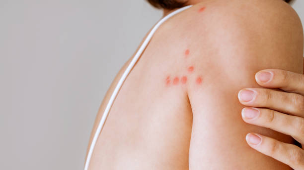 boutons provoqués par des punaises de lit